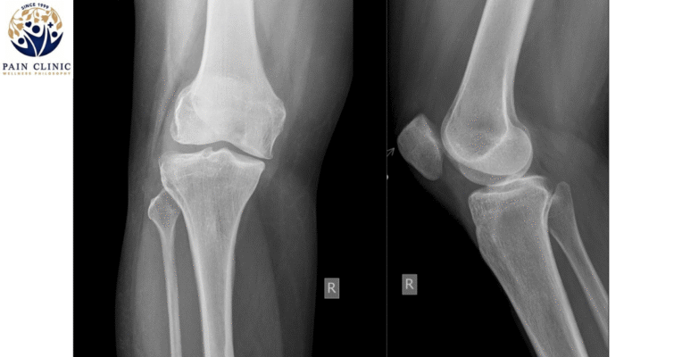 Runner's knee Treatment | Pain Management Clinic | Physiotherapy Singapore | Wellness Philosophy