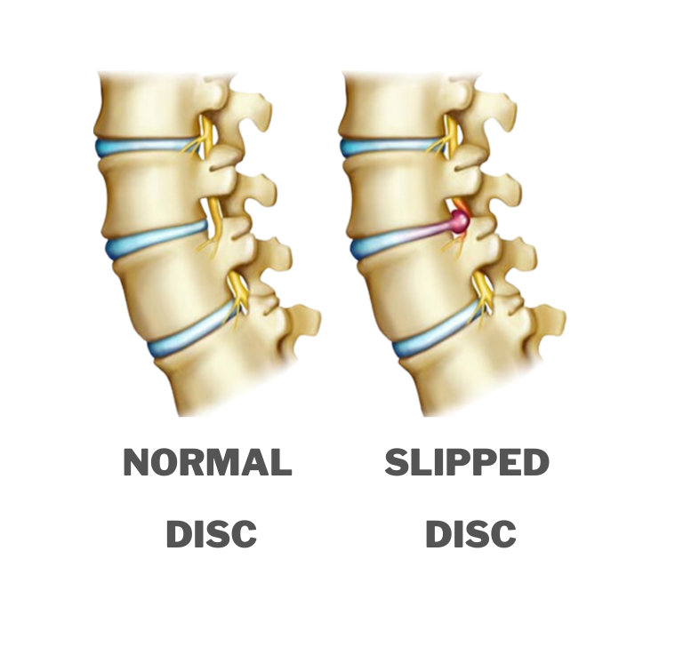 Slipped Disc Therapy Singapore Pain Clinic Wellness Philosophy