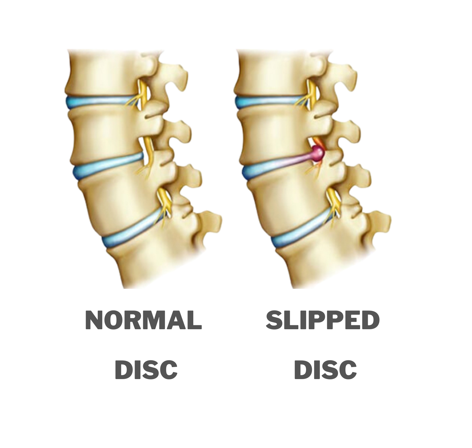 Slipped Disc Diagram