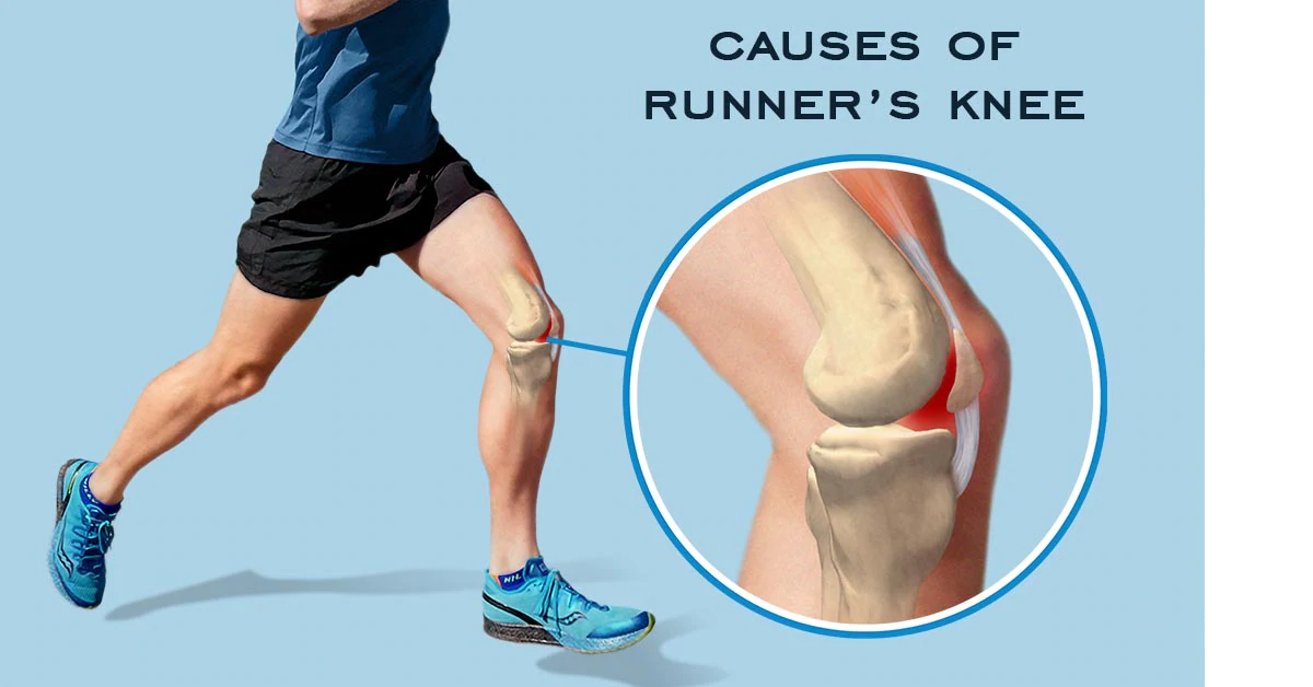 Runner’s Knee Causes Symptoms Precautions And Therapy Programs