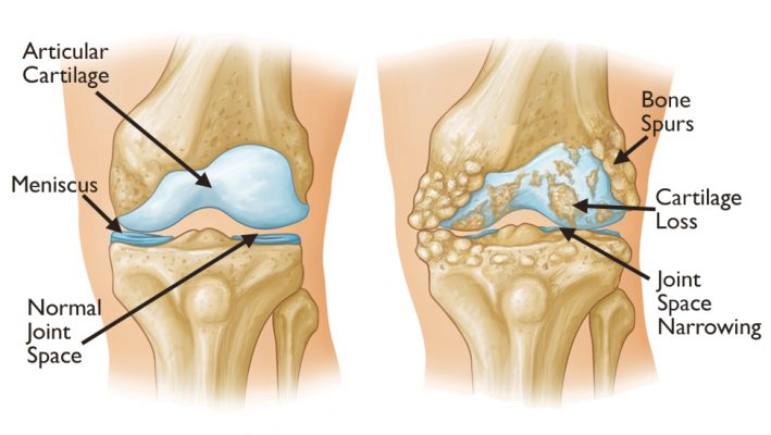 Osteoarthritis knee pain